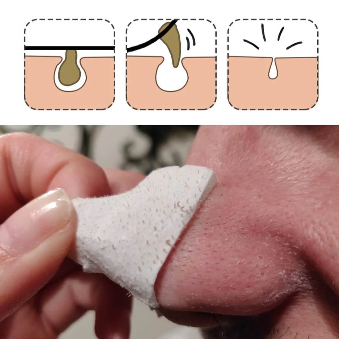 LANBENA Ansigtsmaske til Blackheads