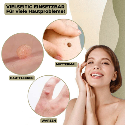 Marcelie | DermaLinx Vortefjerner | Smertefri Fjernelse af Vorter & Modermærker | Til Hjemmet | Uden Kirurgi