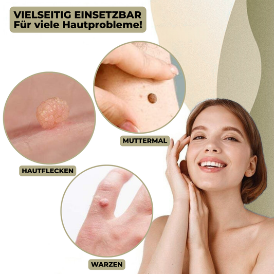 Marcelie | DermaLinx Vortefjerner | Smertefri Fjernelse af Vorter & Modermærker | Til Hjemmet | Uden Kirurgi