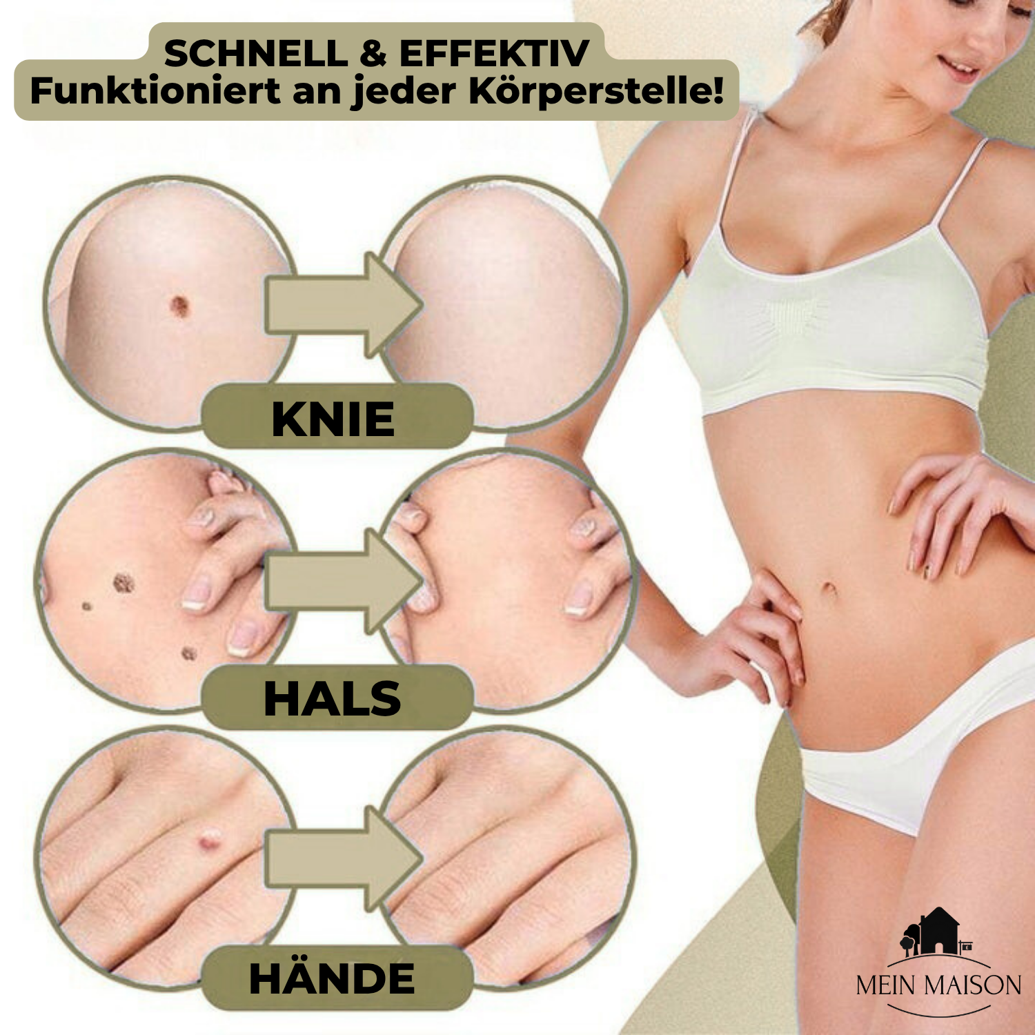 Marcelie | DermaLinx Vortefjerner | Smertefri Fjernelse af Vorter & Modermærker | Til Hjemmet | Uden Kirurgi