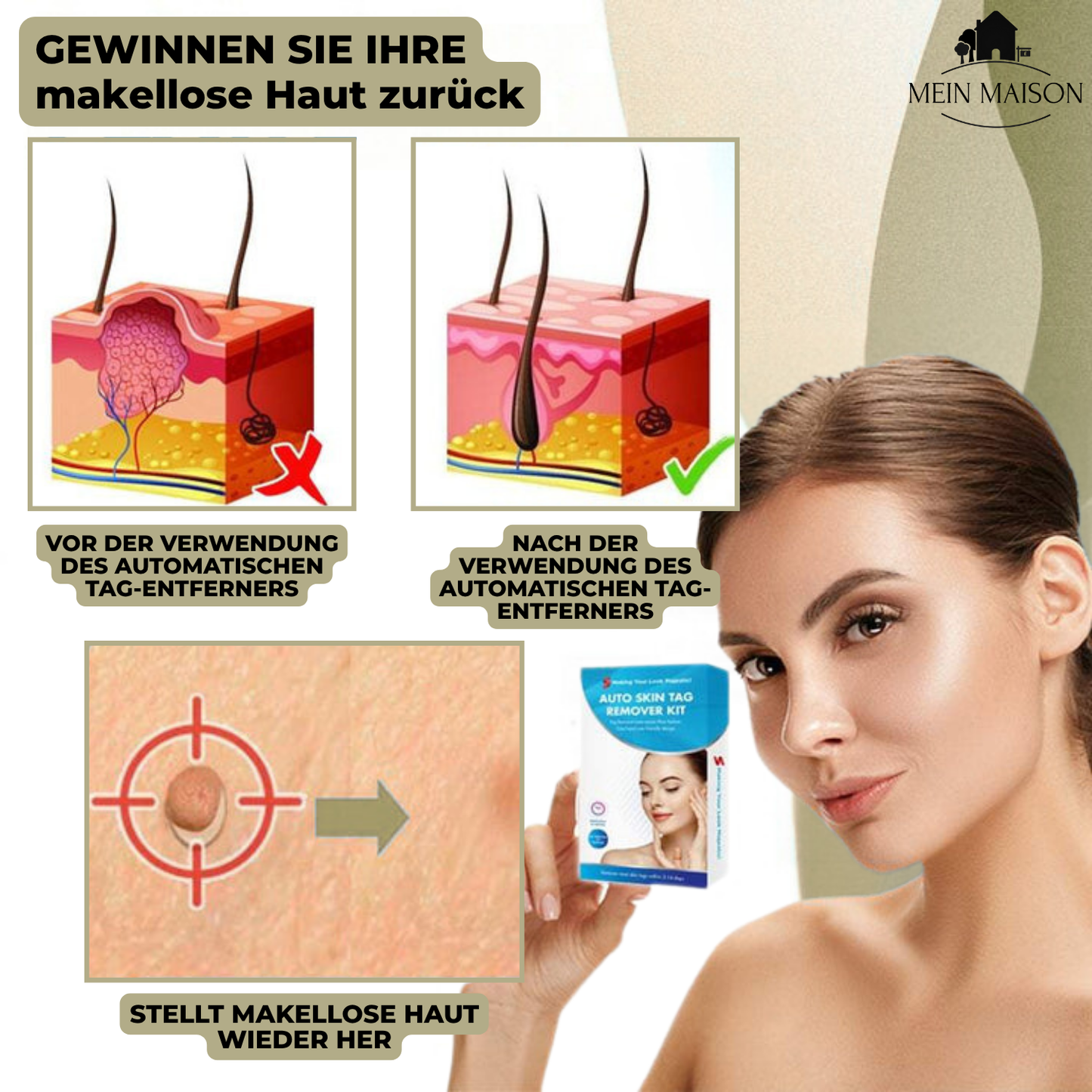 Marcelie | DermaLinx Vortefjerner | Smertefri Fjernelse af Vorter & Modermærker | Til Hjemmet | Uden Kirurgi