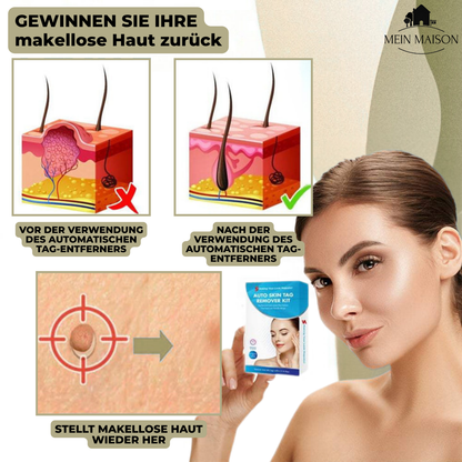 Marcelie | DermaLinx Vortefjerner | Smertefri Fjernelse af Vorter & Modermærker | Til Hjemmet | Uden Kirurgi