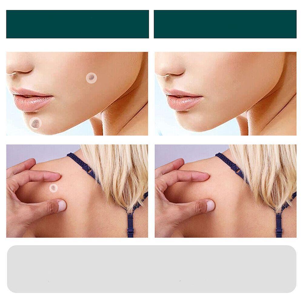 SkinClear - Patches til fjernelse af pletter og vorter Marcelie