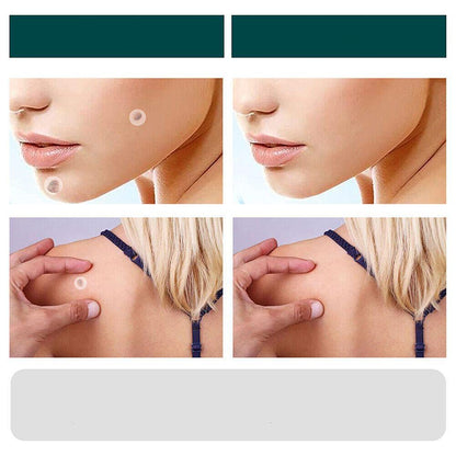 SkinClear - Patches til fjernelse af pletter og vorter Marcelie