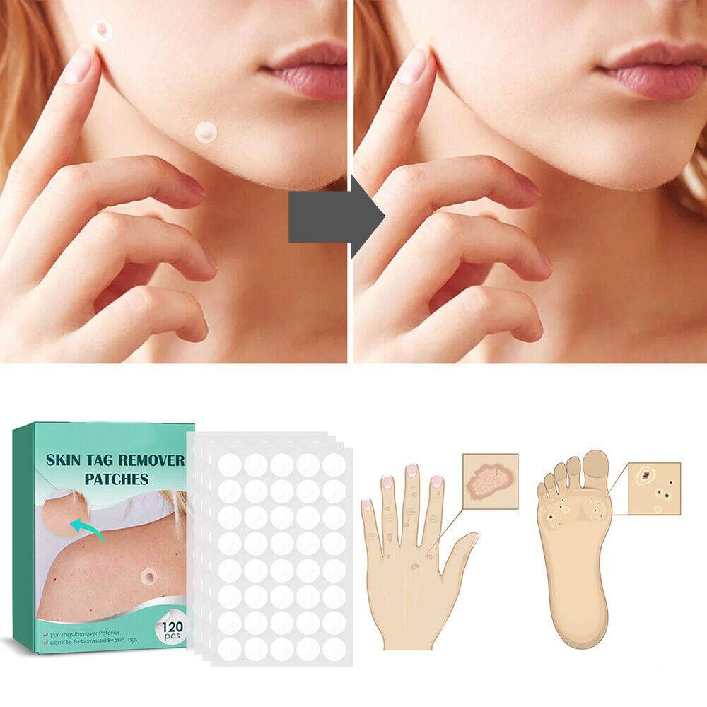 SkinClear - Patches til fjernelse af pletter og vorter Marcelie