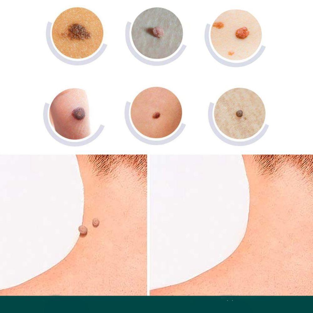 SkinClear - Patches til fjernelse af pletter og vorter Marcelie