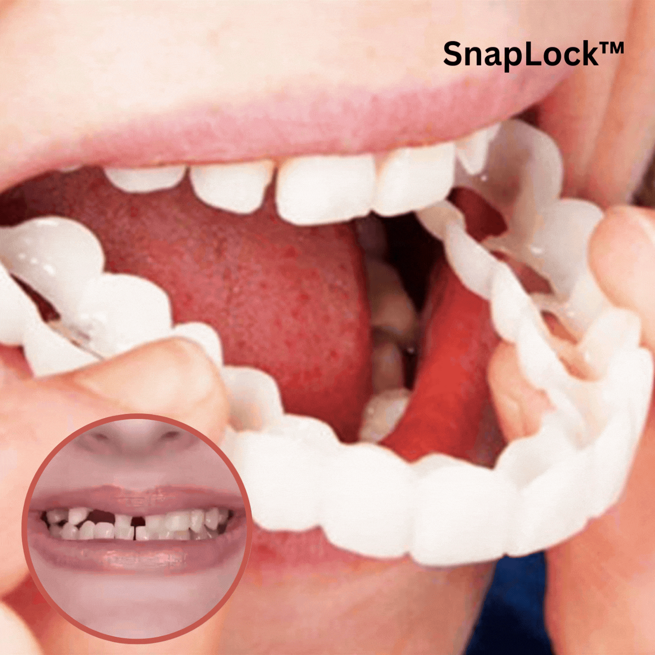 SnapLock Tandproteser | Sikker Komfort til Dit Smil
